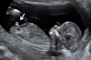 Ecografía 12 semanas niño: ¿Se puede saber el sexo del bebé?