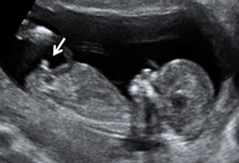 Ecografía 12 semanas niño: ¿Se puede saber el sexo del bebé? 1 ecografia 12 semanas nino se puede saber el sexo del bebe